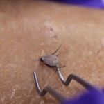 Tick removal videos