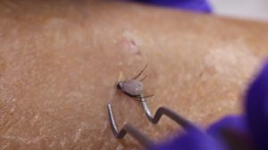 Tick removal videos