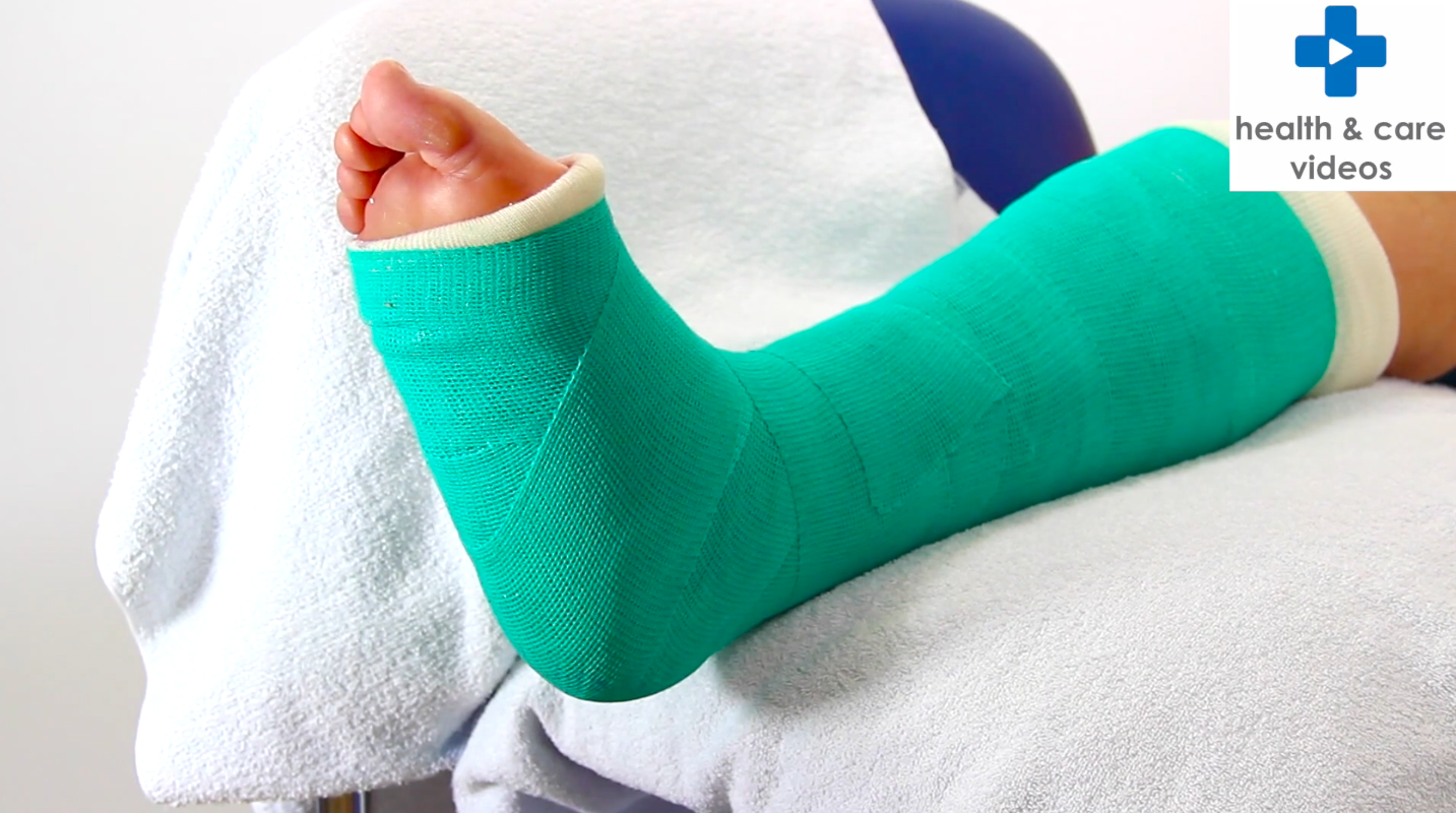 Encouraging Good Care By Stamping Qr Codes On Casts